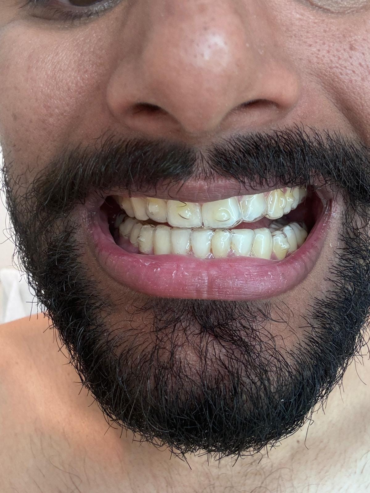 Clear Aligners — The DentalBrace Clinic Bathinda Clear aligners orthodontic treatment result at The DentalBrace Clinic Bathinda — patient Uday P. showing beautifully straight teeth after clear aligner therapy by Dr. Sandeep Kumar MDS Orthodontist, best Invisalign provider in Bathinda Punjab India